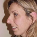 Rhinoplasty Before & After Patient #217