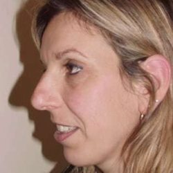 Rhinoplasty Before & After Patient #217