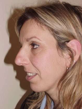 Rhinoplasty Before & After Patient #217