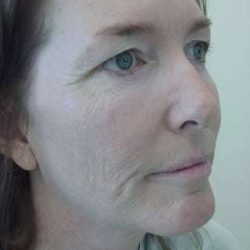 Laser Resurfacing Before & After Patient #133