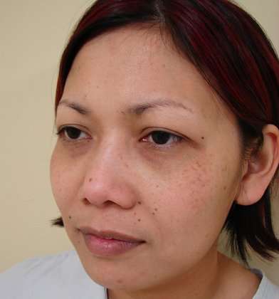 Rhinoplasty Before & After Patient #220
