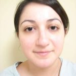 Rhinoplasty Before & After Patient #230