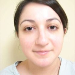 Rhinoplasty Before & After Patient #230