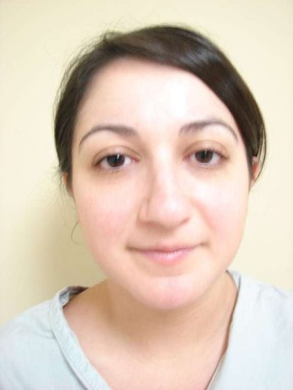 Rhinoplasty Before & After Patient #230