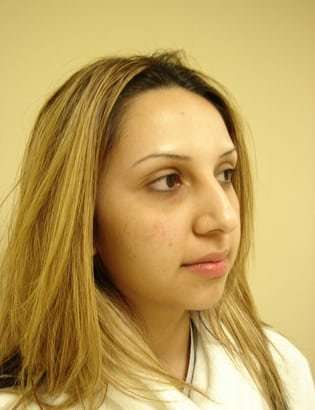 Rhinoplasty Before & After Patient #233