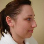 Rhinoplasty Before & After Patient #236