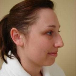 Rhinoplasty Before & After Patient #236