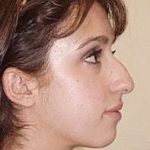 Rhinoplasty Before & After Patient #246