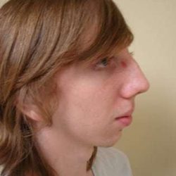 Rhinoplasty Before & After Patient #250