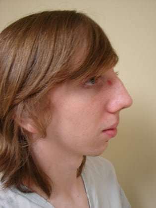 Rhinoplasty Before & After Patient #250