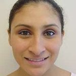 Rhinoplasty Before & After Patient #263
