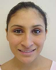 Rhinoplasty Before & After Patient #263