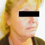Neck Lift Before & After Patient #269