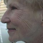 Laser Resurfacing Before & After Patient #136