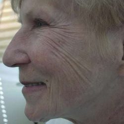 Laser Resurfacing Before & After Patient #136