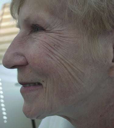 Laser Resurfacing Before & After Patient #136