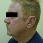 Neck Lift Before & After Patient #275