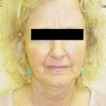 Neck Lift Before & After Patient #278