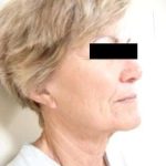 Neck Lift Before & After Patient #281