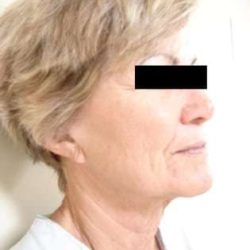 Neck Lift Before & After Patient #281