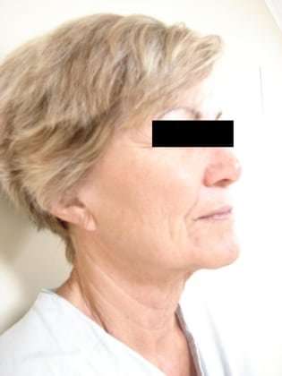 Neck Lift Before & After Patient #281