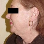 Neck Lift Before & After Patient #284