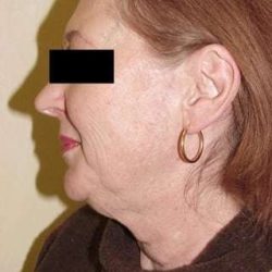 Neck Lift Before & After Patient #284