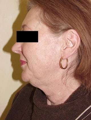 Neck Lift Before & After Patient #284