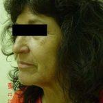 Neck Lift Before & After Patient #287