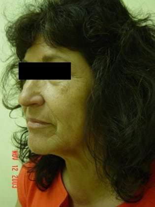 Neck Lift Before & After Patient #287