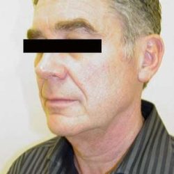 Neck Lift Before & After Patient #293