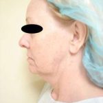Neck Lift Before & After Patient #296