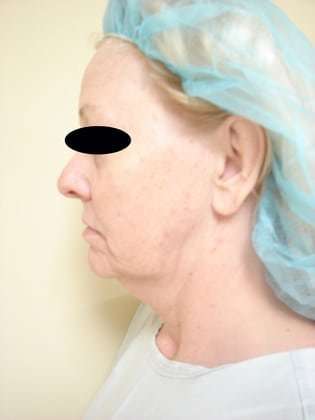 Neck Lift Before & After Patient #296