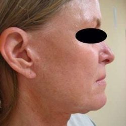 Neck Lift Before & After Patient #299