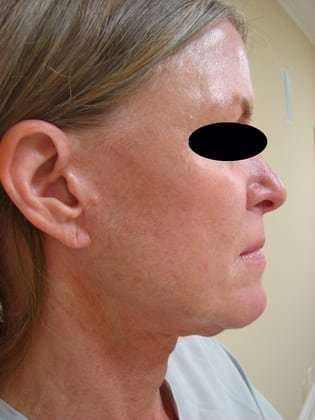 Neck Lift Before & After Patient #299