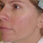 Laser Resurfacing Before & After Patient #139
