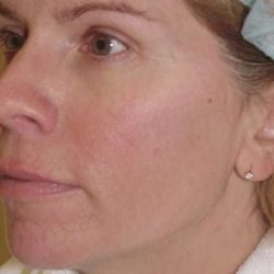 Laser Resurfacing Before & After Patient #139