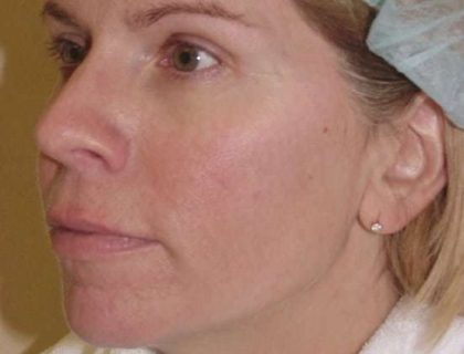 Laser Resurfacing Before & After Patient #139