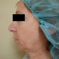 Neck Lift Before & After Patient #302