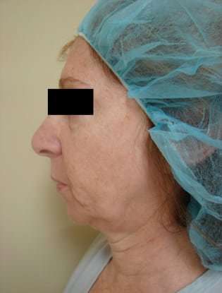 Neck Lift Before & After Patient #302