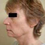 Neck Lift Before & After Patient #306