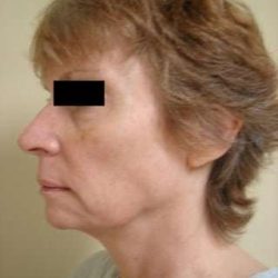 Neck Lift Before & After Patient #306