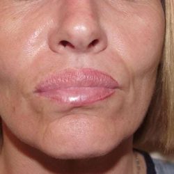 Lip Augmentation Before & After Patient #309