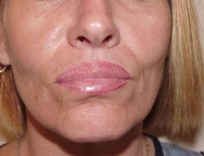 Lip Augmentation Before & After Patient #309