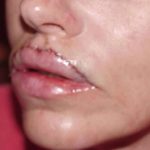 Lip Augmentation Before & After Patient #312
