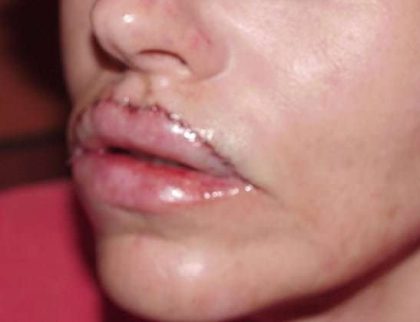 Lip Augmentation Before & After Patient #312