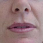 Lip Augmentation Before & After Patient #315