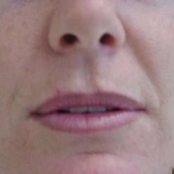 Lip Augmentation Before & After Patient #315