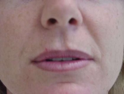 Lip Augmentation Before & After Patient #315