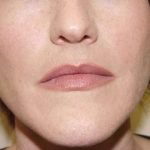 Lip Augmentation Before & After Patient #318